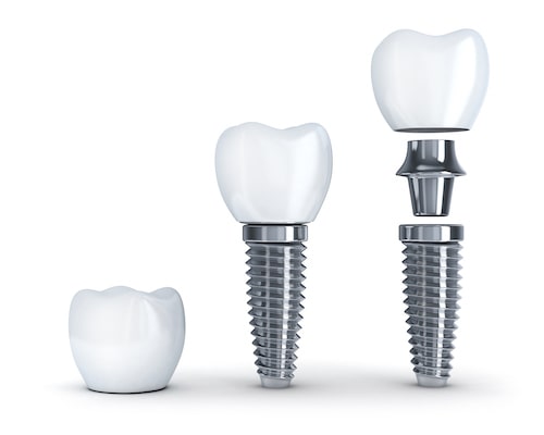 A diagram of the three components of a dental implant