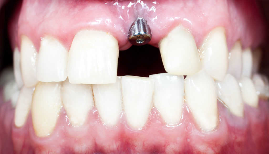 What are the best dental implants 98109?