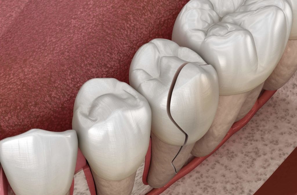 How to avoid cracked teeth in South Lake Union?