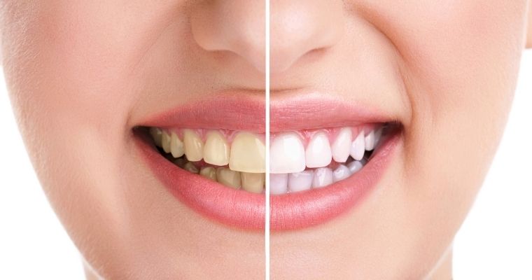 Teeth Whitening: Your Top 5 Questions – ANSWERED!