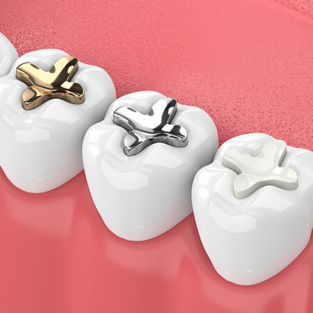 A preview of metal-free white fillings