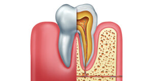 Discover how long a root canal actually takes.